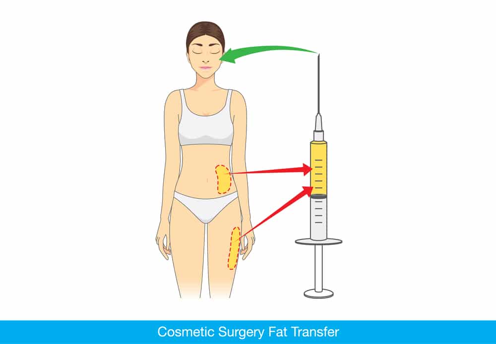 Bagaimana fat transfer dilakukan
