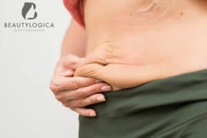 Cara Mengatasi Kulit Kendur Setelah Diet