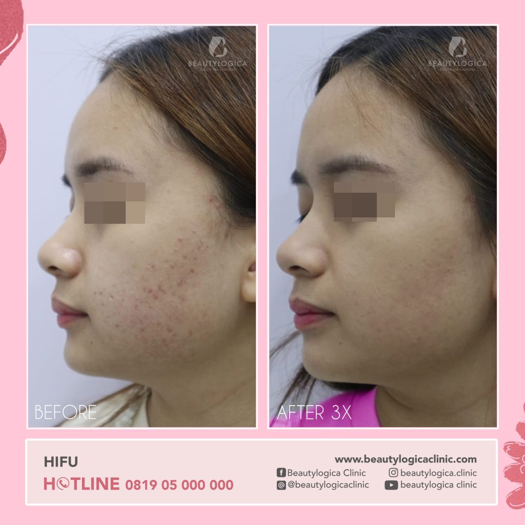 before after HIFU treatment