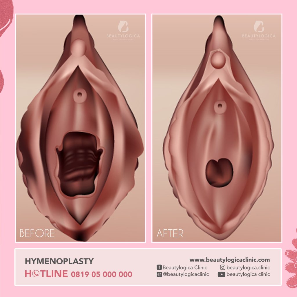 Before After Operasi Hymenoplasty - Operasi Selaput Dara