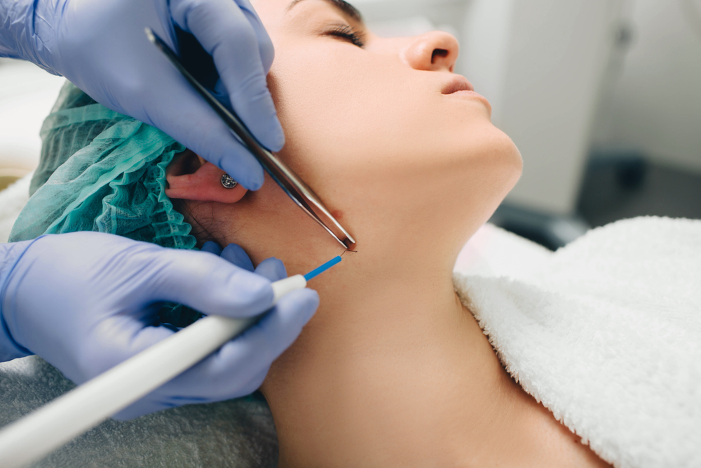 Harga Electrocauter Treatment di Klinik Kecantikan Beautylogica - Murah dan Aman