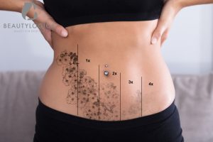 Hasil Hapus Tato dengan Menggunakan Perawatan Laser