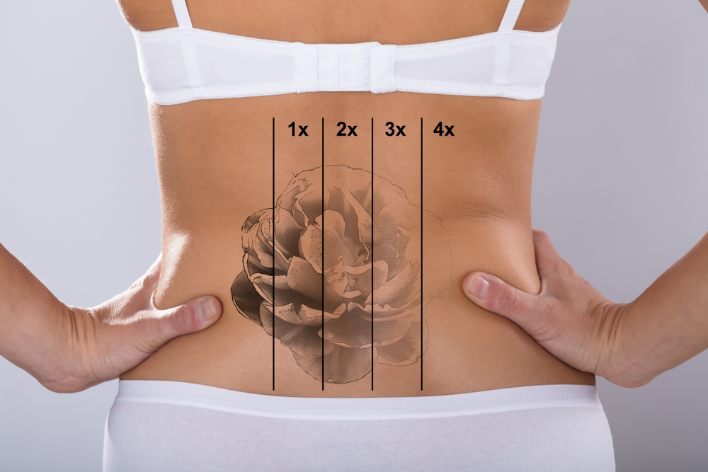 Hasil Menghilangkan Tato dengan Laser Treatment