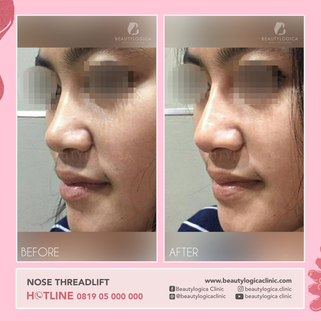 tanam benang hidung before after di Beautylogica Clinic