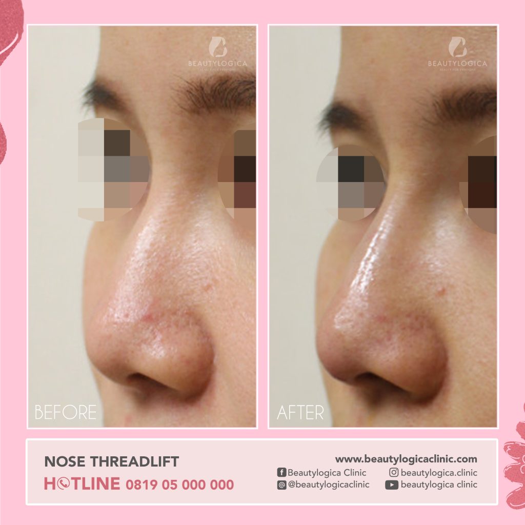 nose thread lift before after di klinik kecantikan