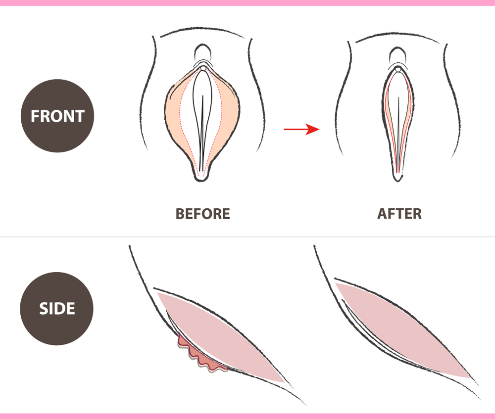 Prosedur Labiaplasty - Operasi Memperbaiki Bibir Vagina