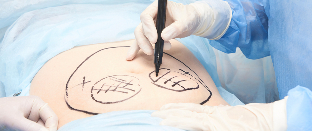 Apa itu Operasi Plastik atau Plastic Surgery