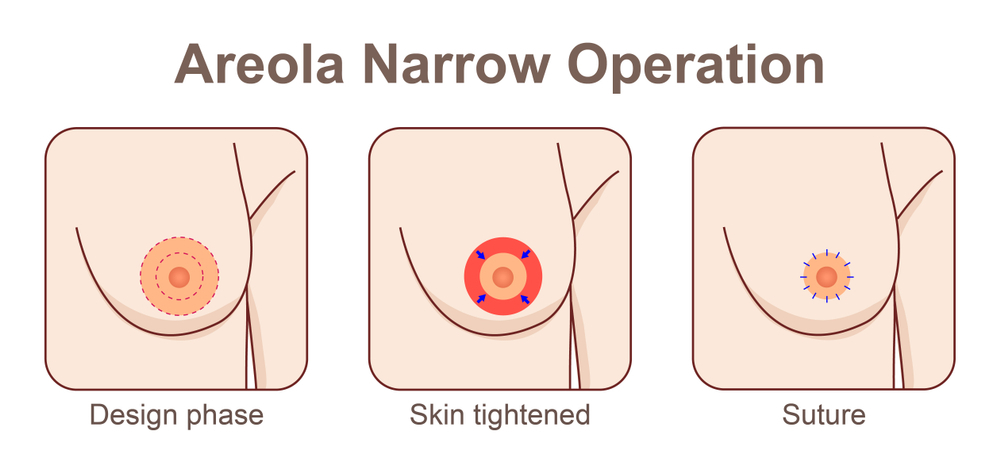 Areola Reduction - Operasi Mengecilkan Lingkaran Hitam Areola