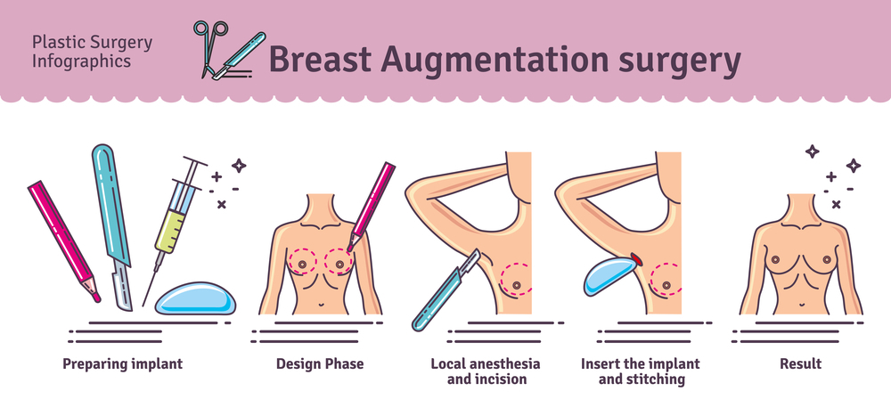 Breast Augmentation - Operasi Implan Payudara