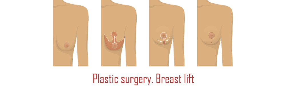 Breast Lift Surgery