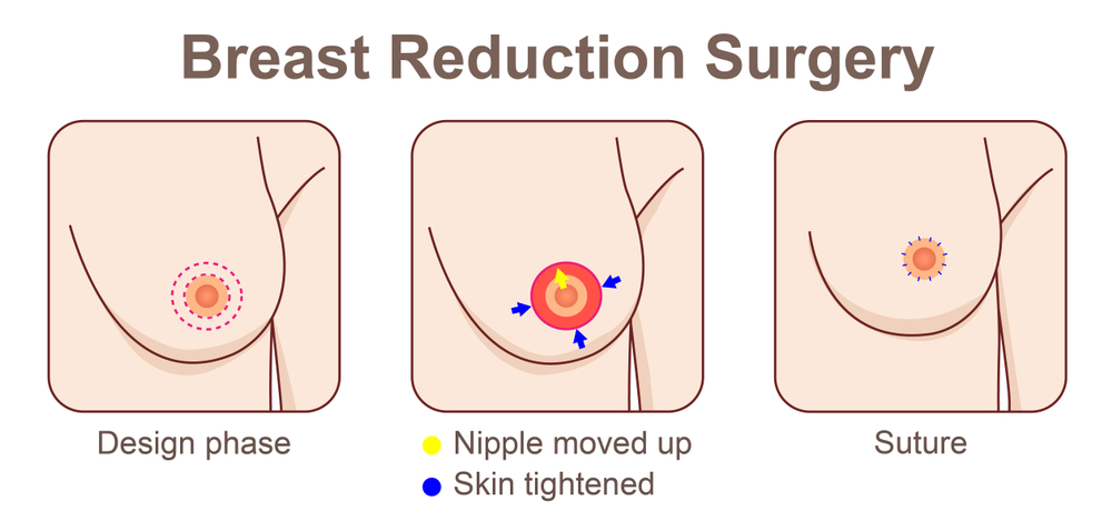 Breast Reduction - Operasi Mengecilkan Payudara