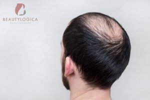 Cara mencegah kebotakan di usia muda