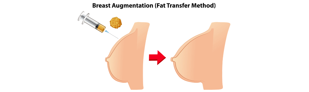 Fat transfer to breast - Transfer lemak ke payudara