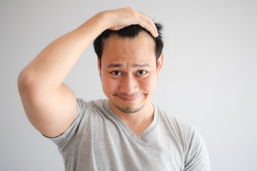 Mencegah kebotakan di saat muda