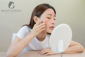 Penyebab Munculnya Komedo dan Cara Menghilangkannya