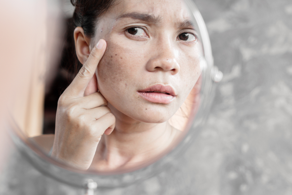 Cara mengatasi melasma