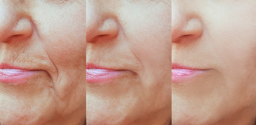 Hasil Thread Lift di klinik kecantikan