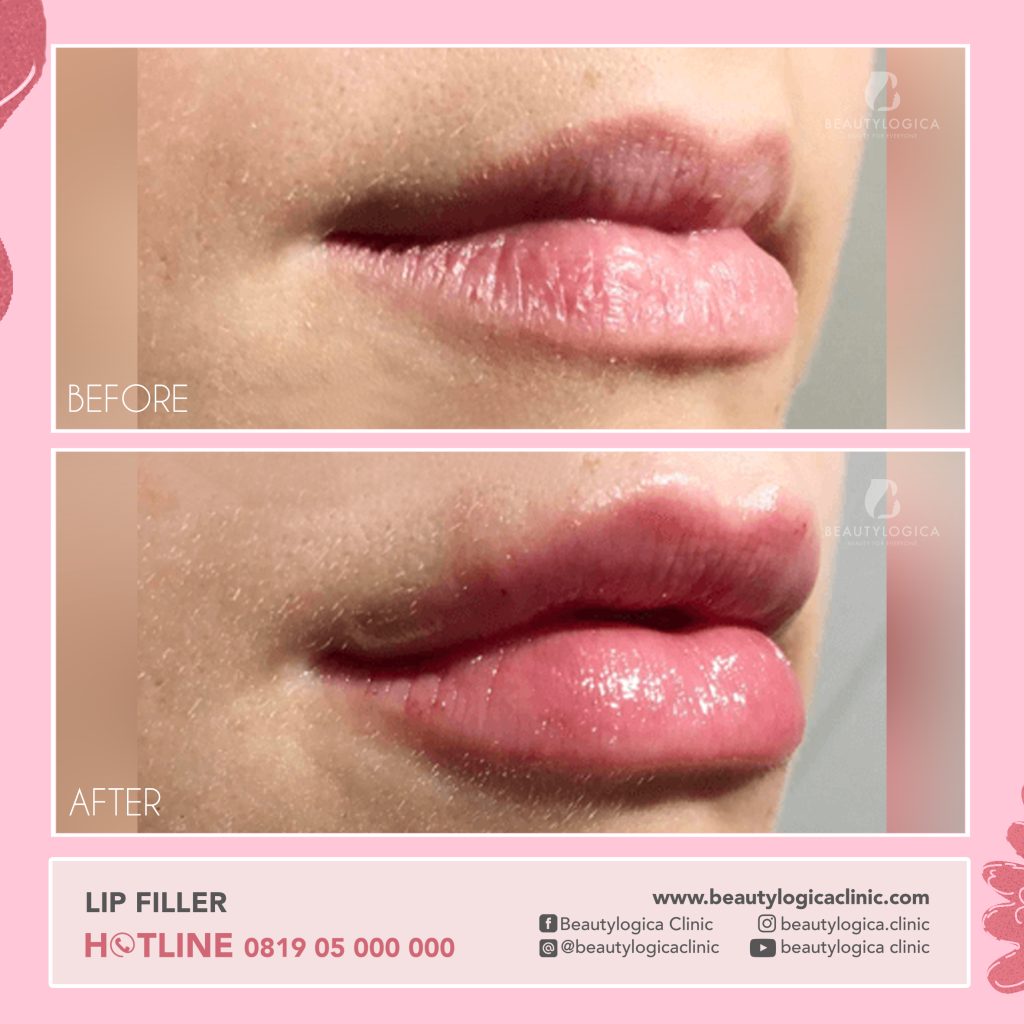 Sebelum dan sesudah filler bibir adalah