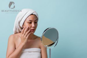Melasma Adalah - Penyebab, Gejala, & Cara Mengatasi