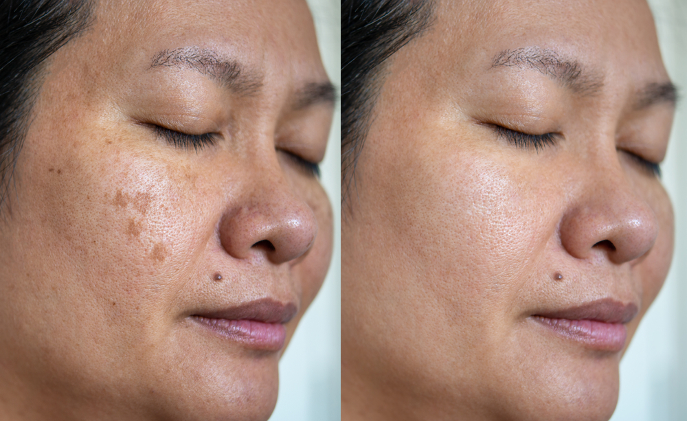 Penyebab dan Pengobatan Melasma