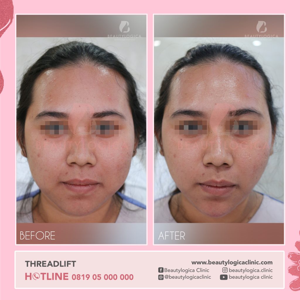 Hasil Thread Lift Before After