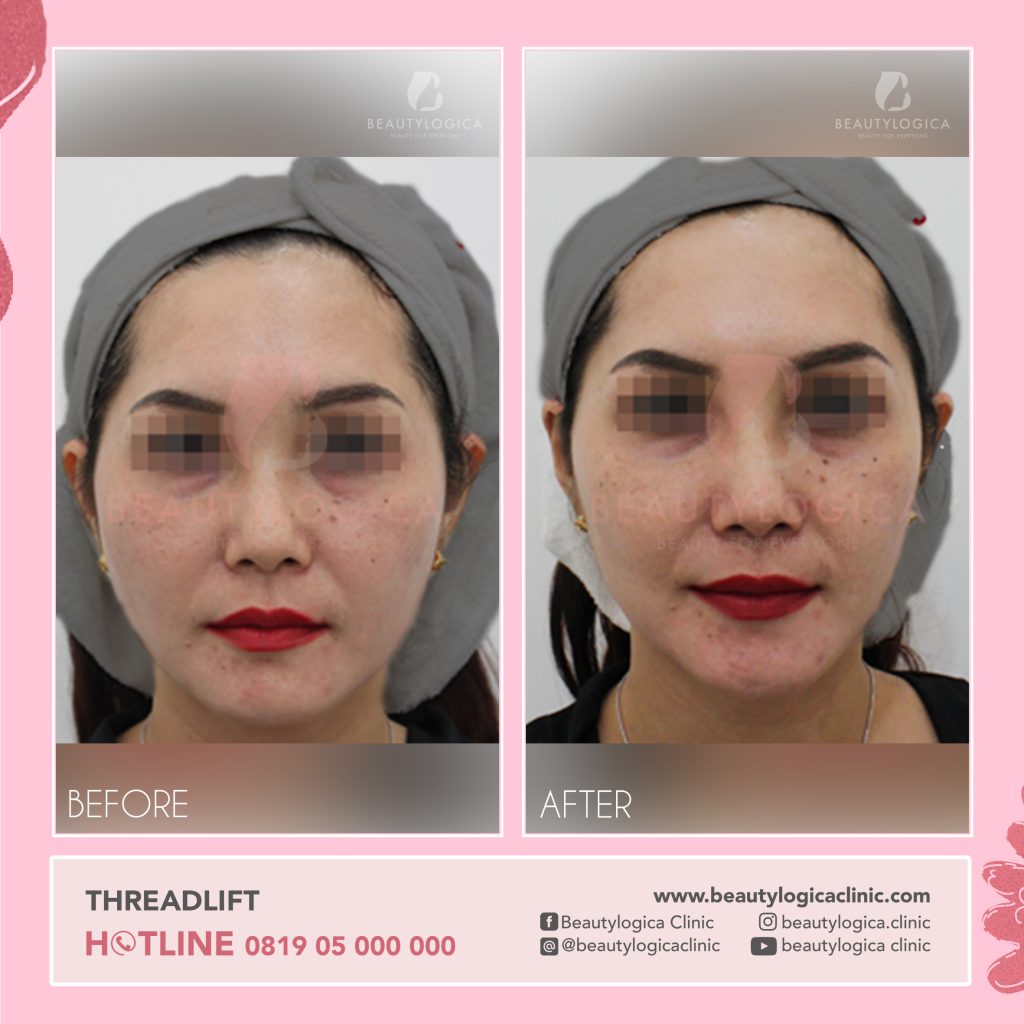 Hasil Tanam Benang di Wajah - Klinik Kecantikan Jakarta
