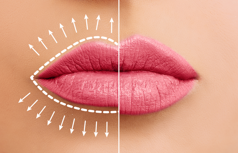 Tips melakukan filler bibir agar aman dan memuaskan
