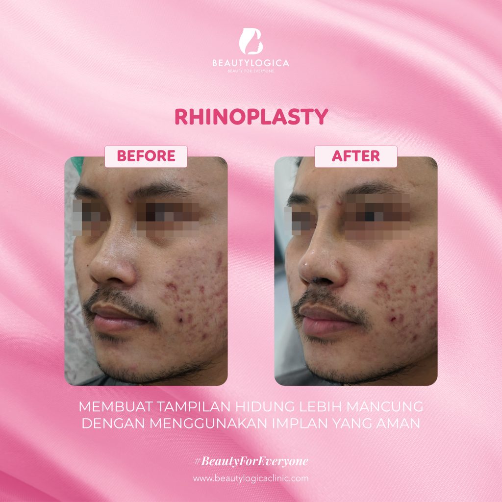 Before After Operasi Hidung agar Mancung