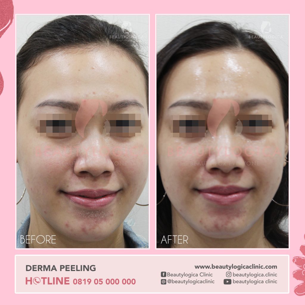 Hasil Chemical Peeling