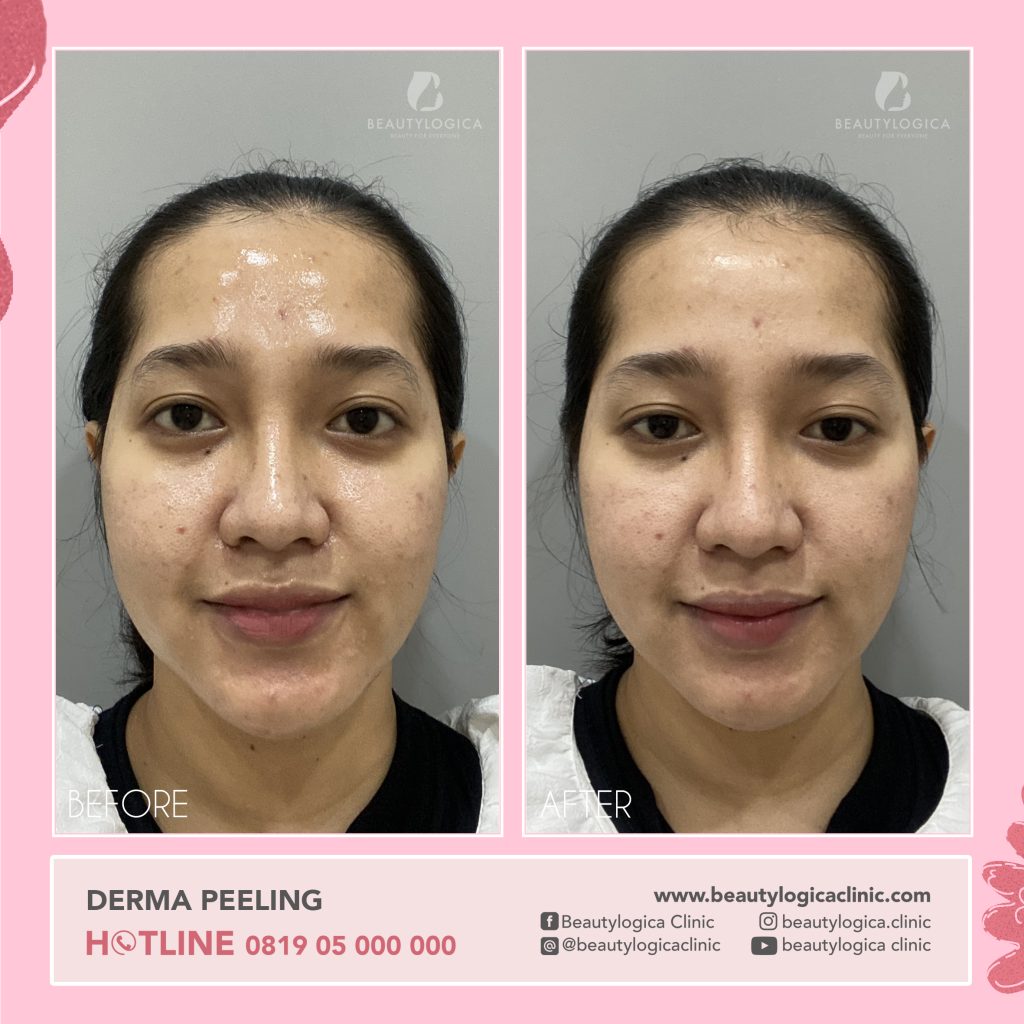 Chemical Peel Before After