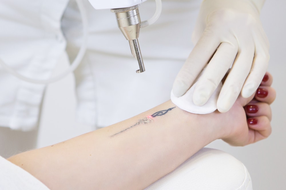 Klinik laser tato di Jakarta