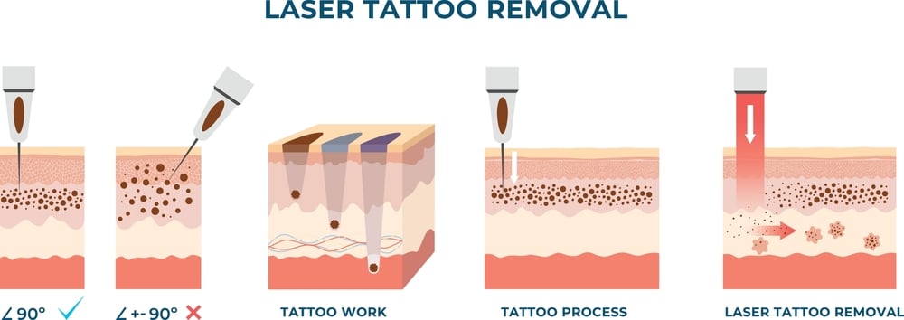 Laser Hapus Tato di Jakarta