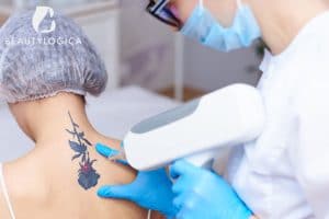 Laser Tato di Jakarta