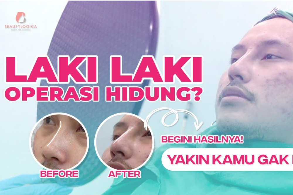 Operasi Hidung agar Mancung, Pria ini Kaget dengan Hasilnya!