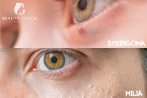 Perbedaan Syringoma dan Milia, Serta Cara Mengobatinya