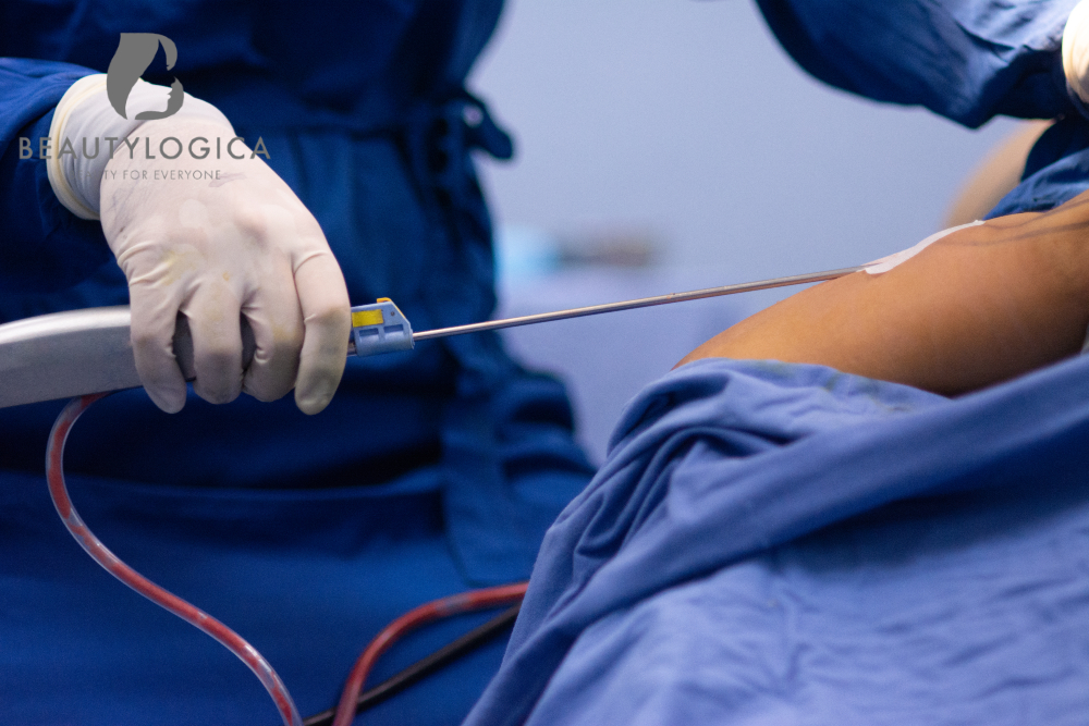 Prosedur Sedot Lemak Perut