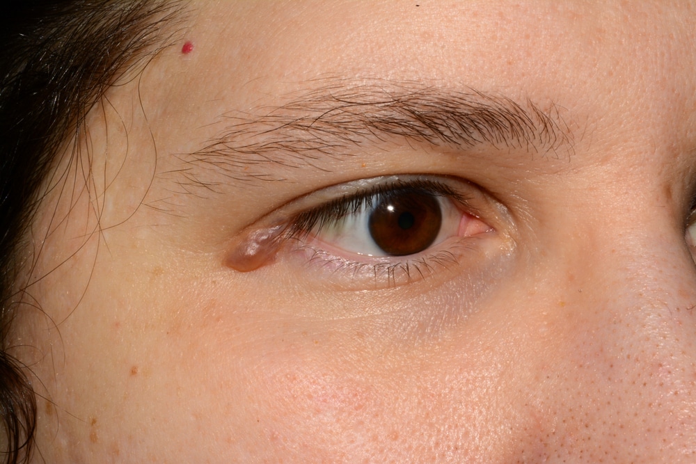 Syringoma