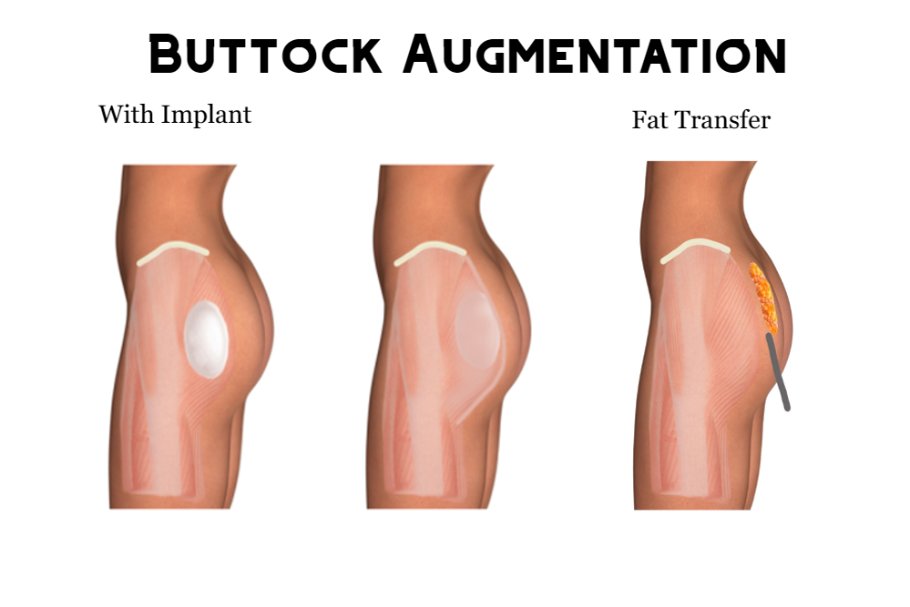 Buttocks Augmentation - Operasi Membesarkan Bokong