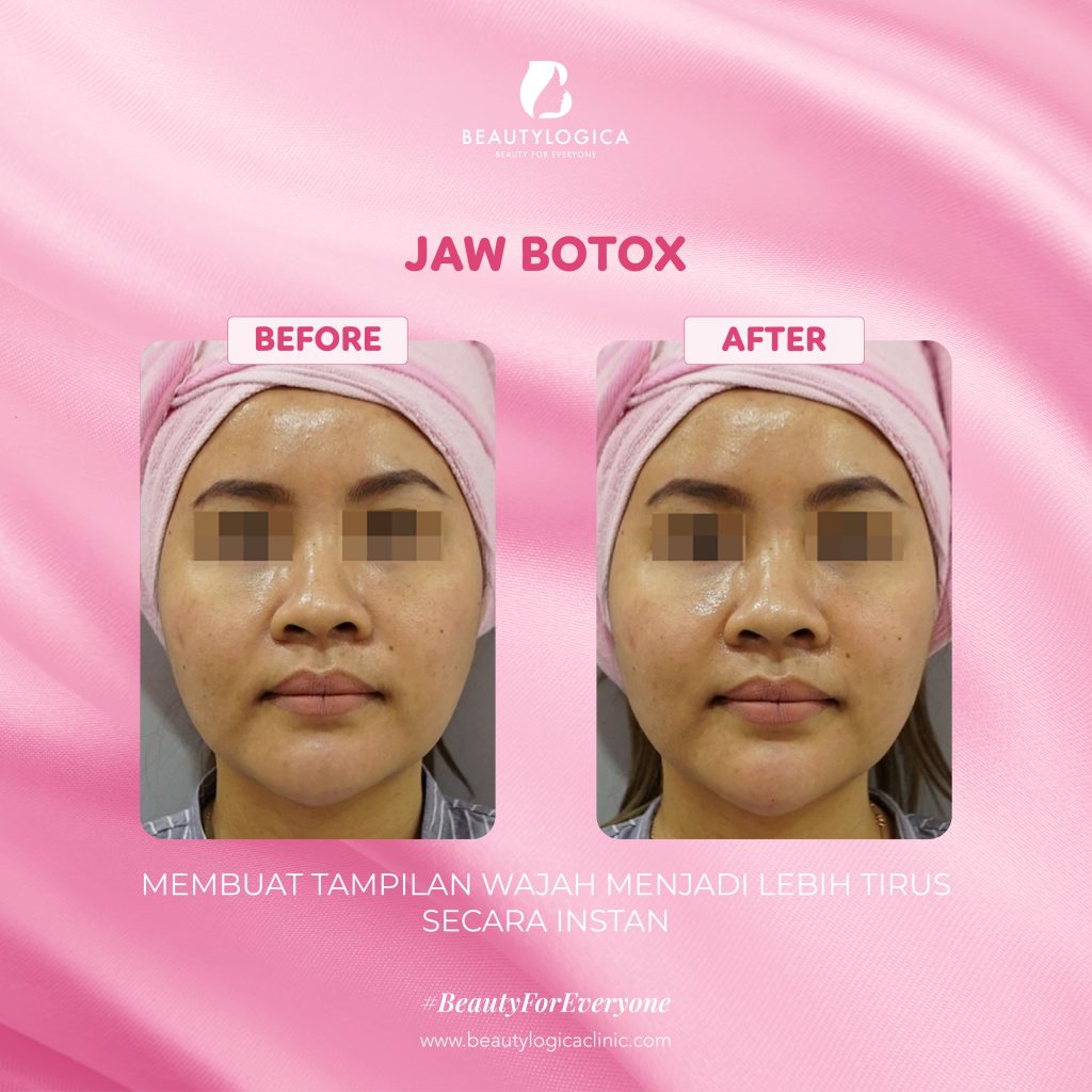 Botox Rahang Before After