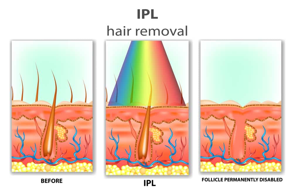 IPL Hair Removal Harga