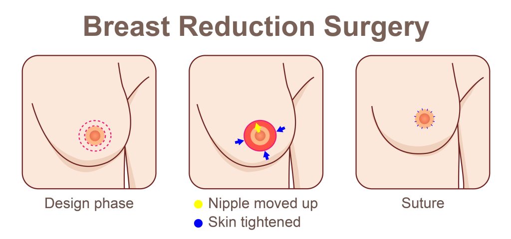 Breast,Reduction,Surgery