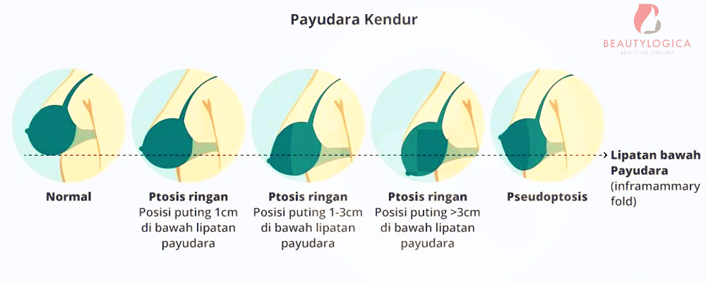 Cara Agar Payudara Tidak Kendur dan Turun