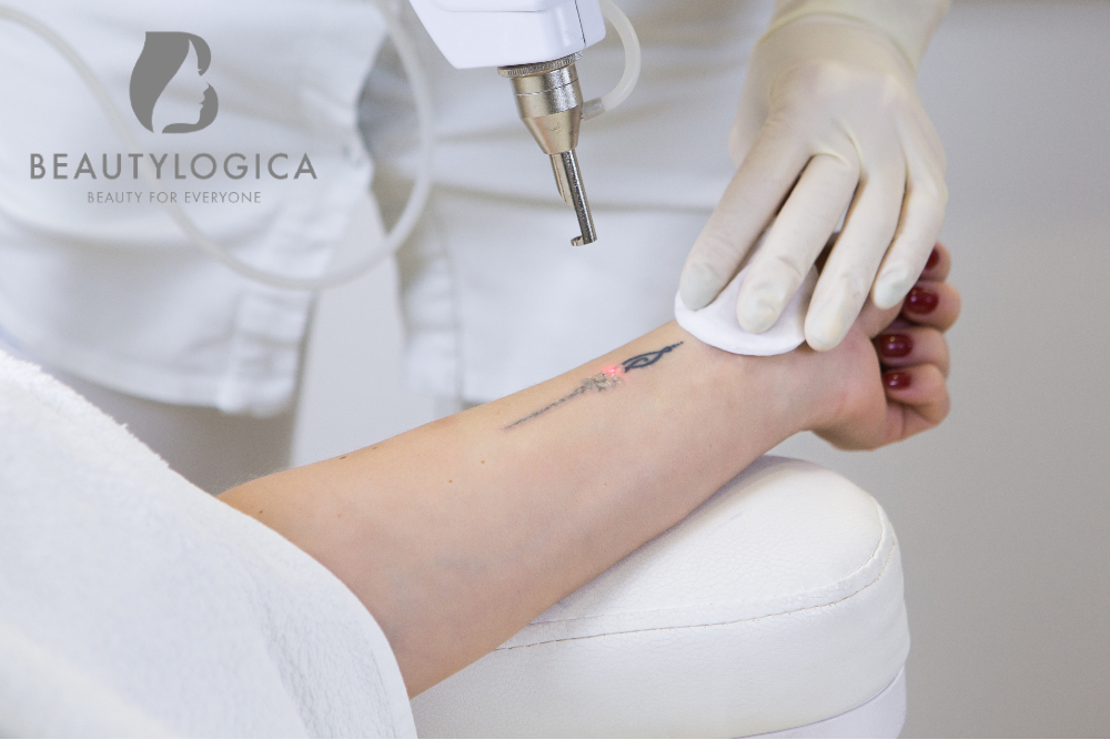 Harga Laser Penghapus Tato di Jakarta