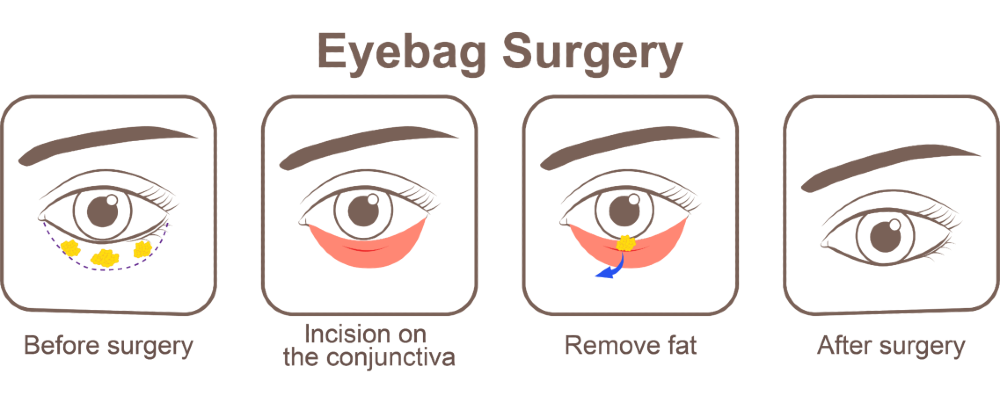 Lower Blepharoplasty - Cara Cepat Menghilangkan Kantung Mata dalam 3 Hari