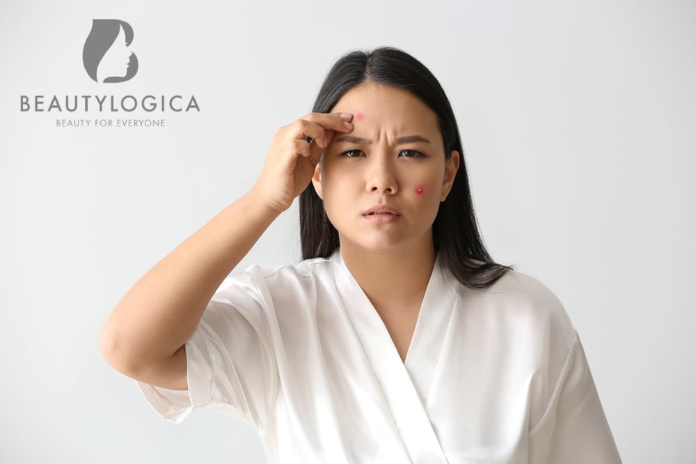 Benarkah Wajah yang Mudah Berjerawat Biasanya Dialami pada Masa Puber