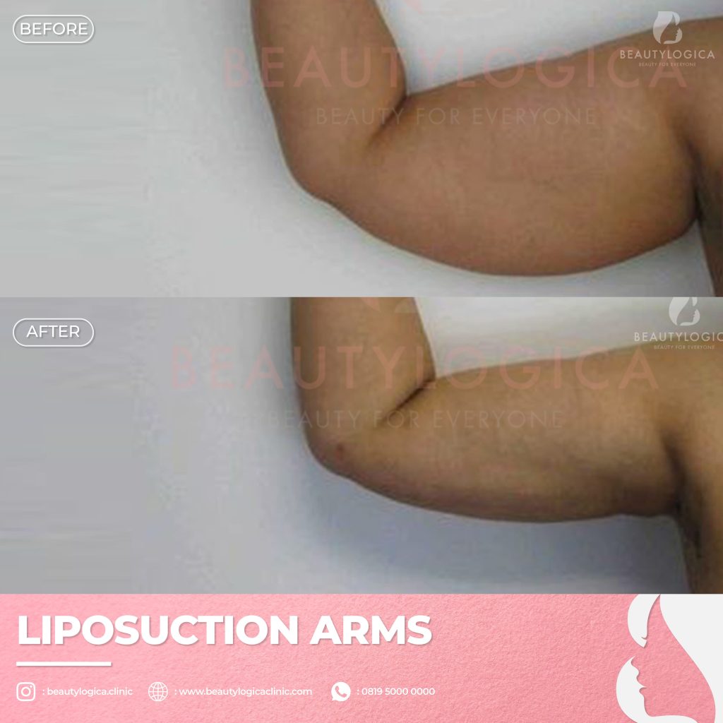 Hasil Sedot Lemak Lengan di Klinik Kecantikan