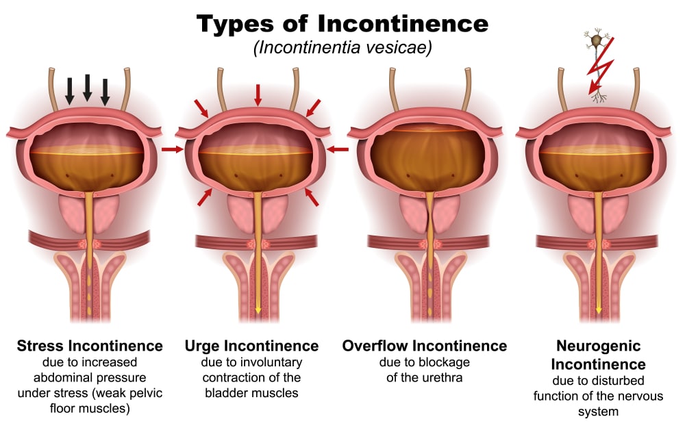 Jenis-jenis Inkontinensia Urine