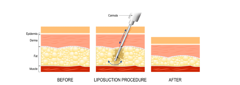 Liposuction Prosedur