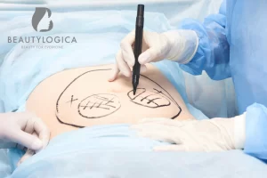 Operasi Sedot Lemak dengan Hasil Terbaik