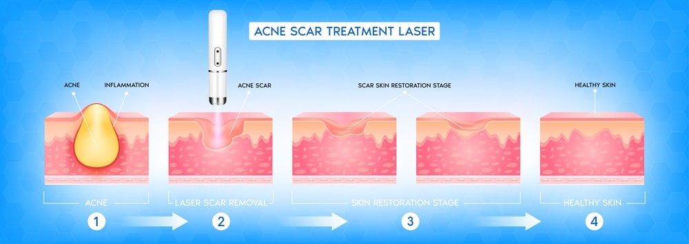 Treatment Menghilangkan Bekas Jerawat
